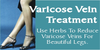 Natural varicose vein treatment or spider vein treatment using varicose vein prevention methods. Consider a natural treatment varicose vein and alternative treatment varicose as a vein varicose vein cure methods. Consider a natural treatment varicose vein and alternative treatment varicose as a vein varicose vein cure